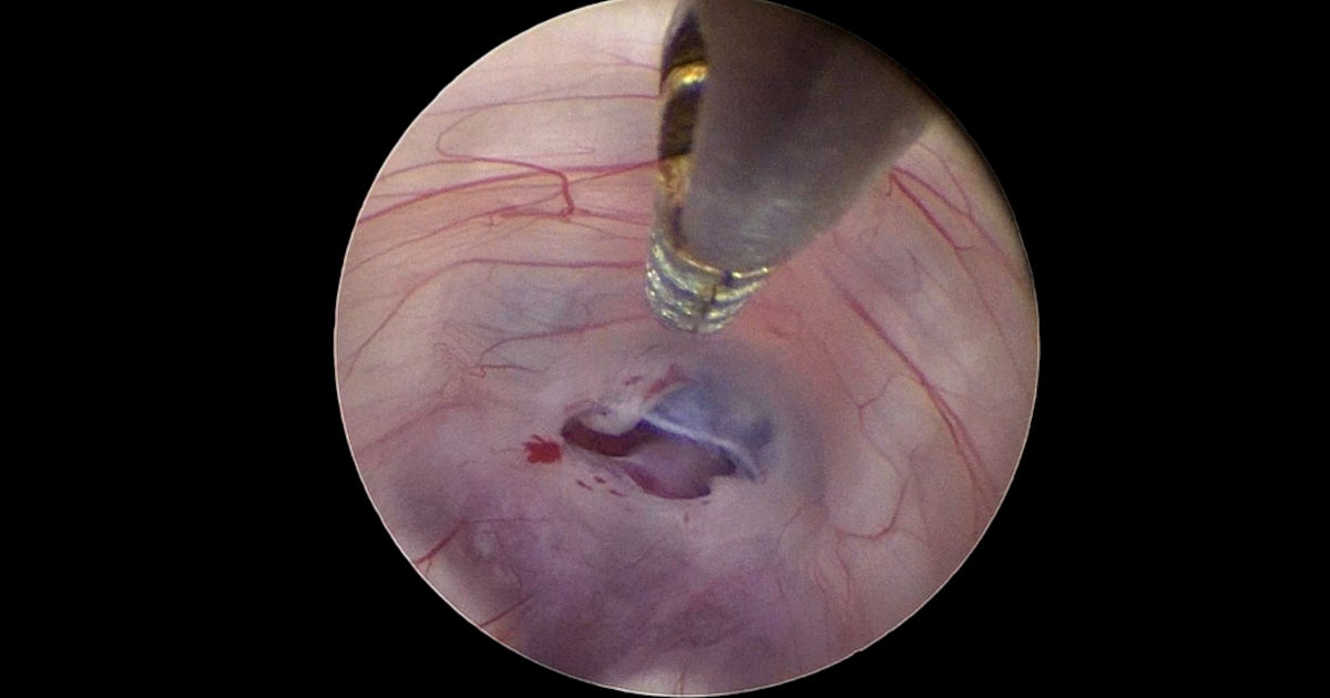 An endoscopic image of an Opening in the floor of the third ventricle