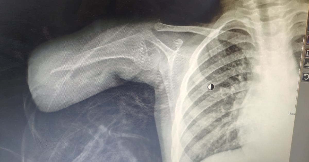 X-ray shows amputated limb