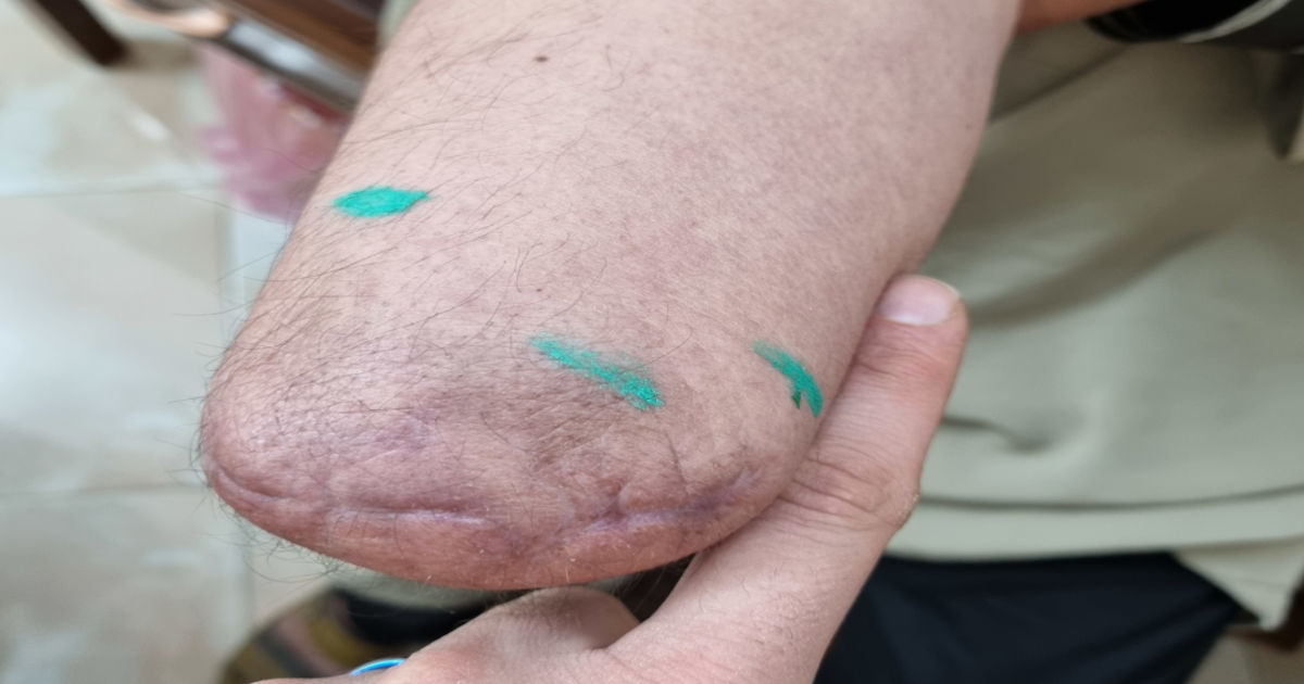 Illustration of a prosthetic hand after neuroma removal surgery